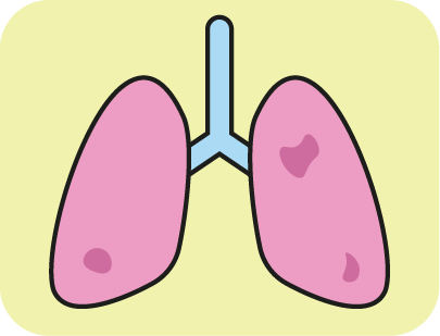 Icono Programa de cribado de c&aacute;ncer de pulm&oacute;n